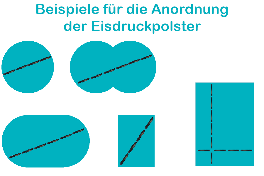 Beispiele für die Anordnung der Eisdruckpolster